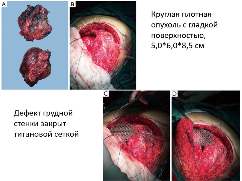 Круглая плотная опухоль с гладкой поверхностью, 5,0*6,0*8,5 см Дефект грудной стенки закрыт титановой сеткой